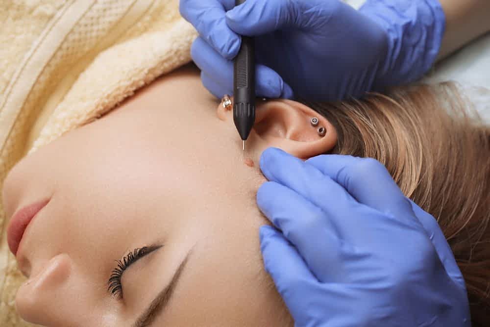 ELECTRO CAUTERIZATION