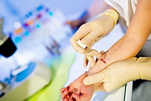 AUTOLOGOUS SERUM TEST