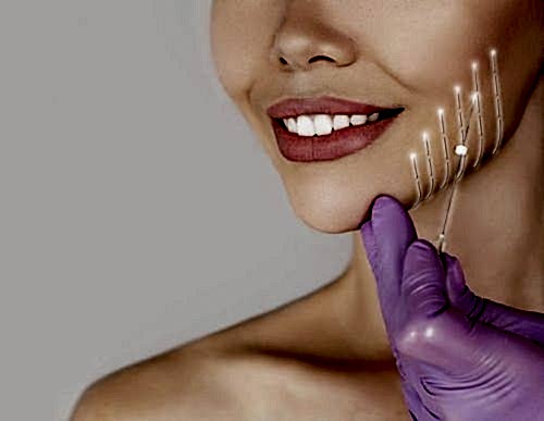 THREAD LIFT