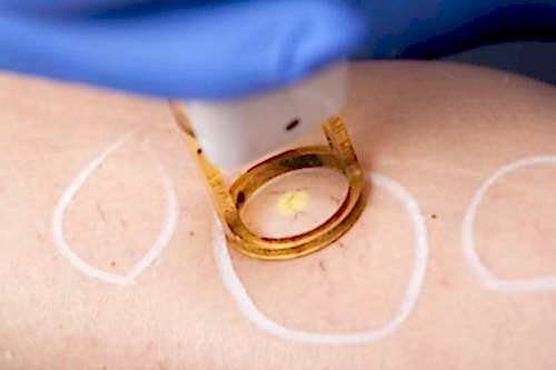 CAPILLARY VEIN TREATMENT