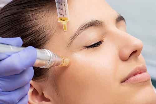 MESOTHERAPY