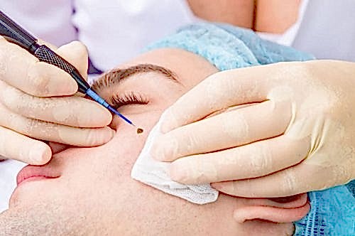 MOLE AND WART CAUTERIZATION