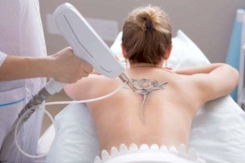 LAZER İLE DÖVME SİLME